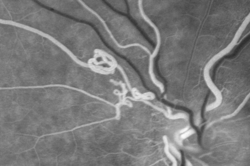 Anomalous Branch Retinal Artery 
59-year-old man  OD 20/25,  OS 20/25.  TORTUOUS RETINAL ARTERY â€“ LEF EYE 
(POSSIBLE GROUP 2 WYBURN-MASON SYNDROME
POSSIBLE ACEPHALIC MIGRAINES )
