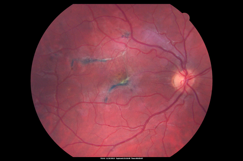 Acute Posterior Multifocal Placoid Pigment Epitheliopathy - 4 years after onset
4 years after presentation - vision 20/80 OD 20/16 OS and there is subretinal fibrosis
