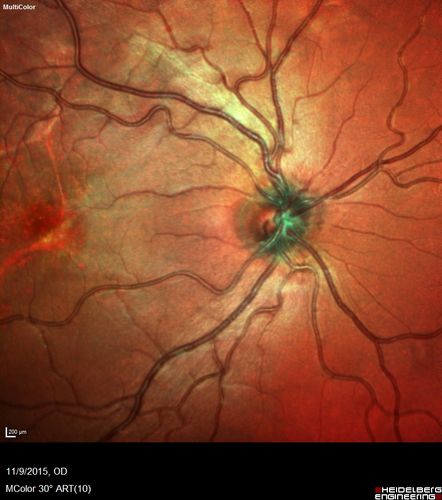 Acute Posterior Multifocal Placoid Pigment Epitheliopathy - 4 years after onset
4 years after presentation - vision 20/80 OD 20/16 OS and there is subretinal fibrosis
