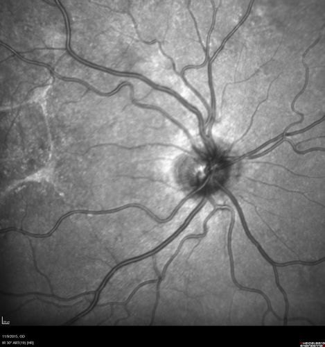 Acute Posterior Multifocal Placoid Pigment Epitheliopathy - 4 years after onset
4 years after presentation - vision 20/80 OD 20/16 OS and there is subretinal fibrosis
