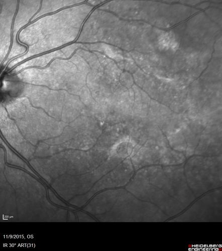 Acute Posterior Multifocal Placoid Pigment Epitheliopathy - 4 years after onset
4 years after presentation - vision 20/80 OD 20/16 OS and there is subretinal fibrosis
