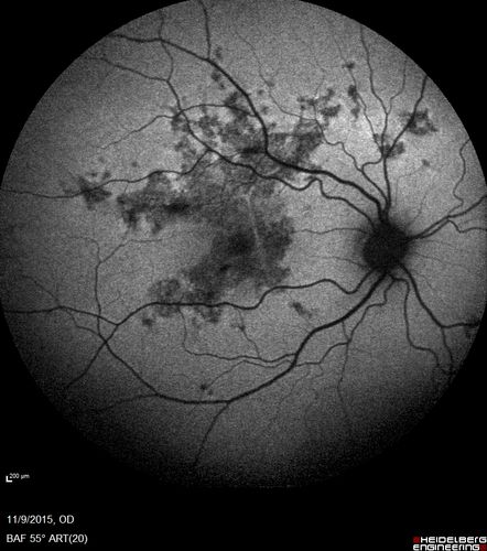 Acute Posterior Multifocal Placoid Pigment Epitheliopathy - 4 years after onset
4 years after presentation - vision 20/80 OD 20/16 OS and there is subretinal fibrosis
