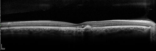 Acute Posterior Multifocal Placoid Pigment Epitheliopathy - 4 years after onset
4 years after presentation - vision 20/80 OD 20/16 OS and there is subretinal fibrosis
