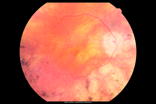 Retinitis Pigmentosa - Autosomal Recessive - 82 year old man with Good Vision
VA 20/25, 20/32 - Bone spicules in periphery - FAF is very symmetric
