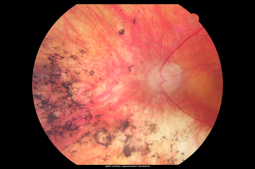 Retinitis Pigmentosa - Autosomal Recessive - 82 year old man with Good Vision
VA 20/25, 20/32 - Bone spicules in periphery - FAF is very symmetric
