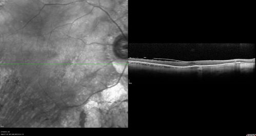 Retinitis Pigmentosa - Autosomal Recessive - 82 year old man with Good Vision
VA 20/25, 20/32 - Bone spicules in periphery - FAF is very symmetric
