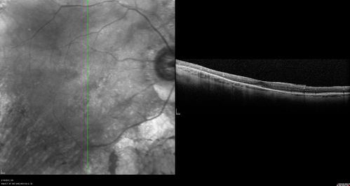 Retinitis Pigmentosa - Autosomal Recessive - 82 year old man with Good Vision
VA 20/25, 20/32 - Bone spicules in periphery - FAF is very symmetric
