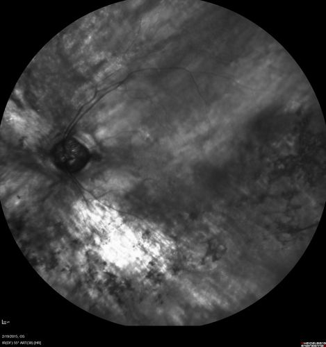 Retinitis Pigmentosa - Autosomal Recessive - 82 year old man with Good Vision
VA 20/25, 20/32 - Bone spicules in periphery - FAF is very symmetric
