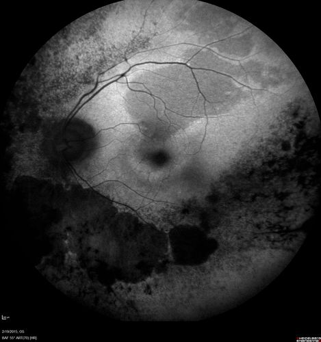 Retinitis Pigmentosa - Autosomal Recessive - 82 year old man with Good Vision
VA 20/25, 20/32 - Bone spicules in periphery - FAF is very symmetric
