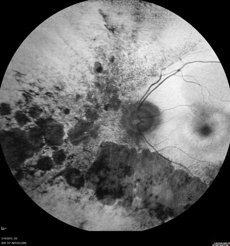 Retinitis Pigmentosa - Autosomal Recessive - 82 year old man with Good Vision
VA 20/25, 20/32 - Bone spicules in periphery - FAF is very symmetric
