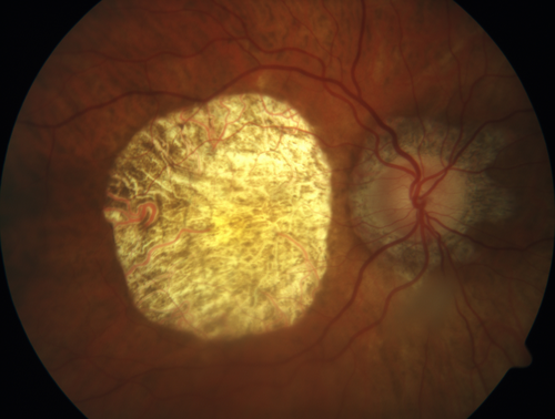 Central Areolar Choroidal Sclerosis
66 year old woman with 20/160 vision - loss of central vision 11 years ago.  Strong family history of vision loss.
