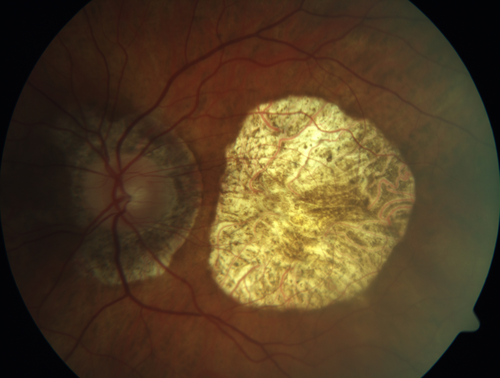 Central Areolar Choroidal Sclerosis
66 year old woman with 20/160 vision - loss of central vision 11 years ago.  Strong family history of vision loss.
