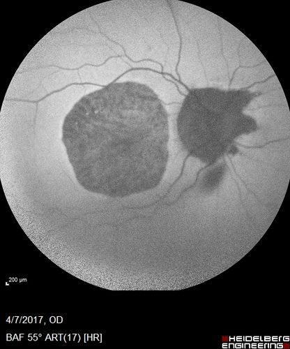 Central Areolar Choroidal Sclerosis
66 year old woman with 20/160 vision - loss of central vision 11 years ago.  Strong family history of vision loss.
