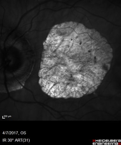 Central Areolar Choroidal Sclerosis
66 year old woman with 20/160 vision - loss of central vision 11 years ago.  Strong family history of vision loss.
