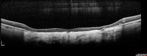 Central Areolar Choroidal Sclerosis
66 year old woman with 20/160 vision - loss of central vision 11 years ago.  Strong family history of vision loss.
