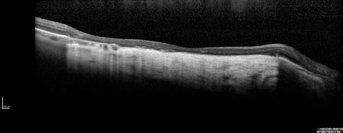 Central Areolar Choroidal Sclerosis
66 year old woman with 20/160 vision - loss of central vision 11 years ago.  Strong family history of vision loss.
