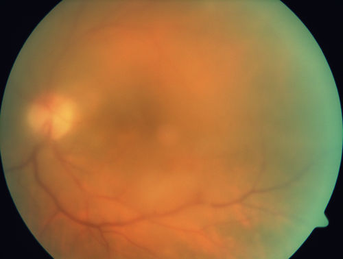 Primary Toxoplasmosis
76 year old man with blurred vision left eye.  He improved to 20/25 in 2 months with valtrex.  No steroids were given
