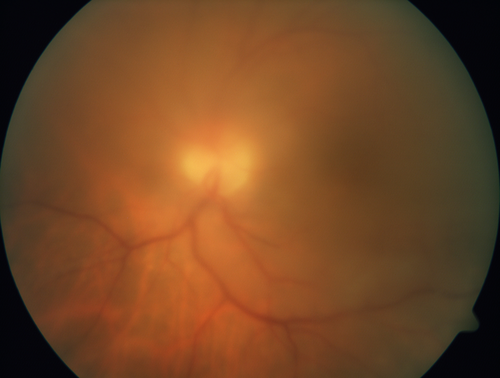 Primary Toxoplasmosis
76 year old man with blurred vision left eye.  He improved to 20/25 in 2 months with valtrex.  No steroids were given
