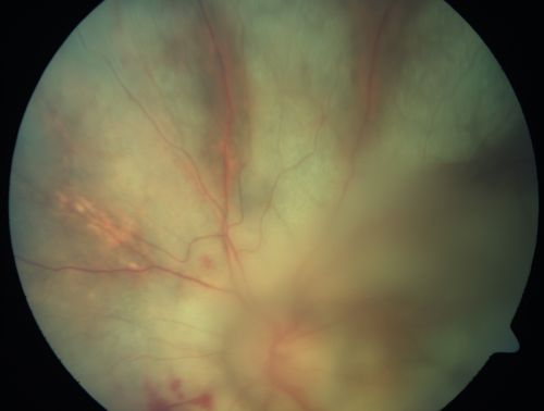 Progressive Outer Retinal Necrosis 77 Year Old Woman with CLL (Acute Retinal Necrosis) (PORN - ARN)
77-year-old woman with CLL who had shingles on the left side of her face about 6 weeks ago then she developed a dendrite in the cornea which was treating about four weeks ago.  She noticed severe vision loss in the left eye just a few days ago and you saw retinitis and she comes in because of that.   Vision OD is 20/25, OS is hand motion
