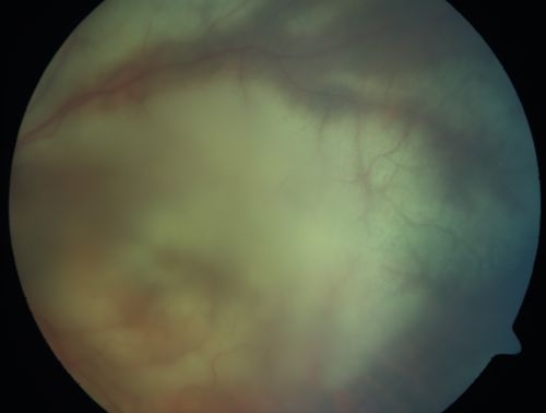 Progressive Outer Retinal Necrosis 77 Year Old Woman with CLL (Acute Retinal Necrosis) (PORN - ARN)
77-year-old woman with CLL who had shingles on the left side of her face about 6 weeks ago then she developed a dendrite in the cornea which was treating about four weeks ago.  She noticed severe vision loss in the left eye just a few days ago and you saw retinitis and she comes in because of that.   Vision OD is 20/25, OS is hand motion
