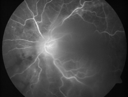Progressive Outer Retinal Necrosis 77 Year Old Woman with CLL (Acute Retinal Necrosis) (PORN - ARN)
77-year-old woman with CLL who had shingles on the left side of her face about 6 weeks ago then she developed a dendrite in the cornea which was treating about four weeks ago.  She noticed severe vision loss in the left eye just a few days ago and you saw retinitis and she comes in because of that.   Vision OD is 20/25, OS is hand motion
