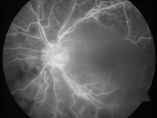 Progressive Outer Retinal Necrosis 77 Year Old Woman with CLL (Acute Retinal Necrosis) (PORN - ARN)
77-year-old woman with CLL who had shingles on the left side of her face about 6 weeks ago then she developed a dendrite in the cornea which was treating about four weeks ago.  She noticed severe vision loss in the left eye just a few days ago and you saw retinitis and she comes in because of that.   Vision OD is 20/25, OS is hand motion
