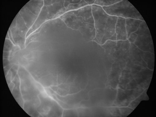 Progressive Outer Retinal Necrosis 77 Year Old Woman with CLL (Acute Retinal Necrosis) (PORN - ARN)
77-year-old woman with CLL who had shingles on the left side of her face about 6 weeks ago then she developed a dendrite in the cornea which was treating about four weeks ago.  She noticed severe vision loss in the left eye just a few days ago and you saw retinitis and she comes in because of that.   Vision OD is 20/25, OS is hand motion
