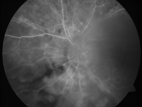 Progressive Outer Retinal Necrosis 77 Year Old Woman with CLL (Acute Retinal Necrosis) (PORN - ARN)
77-year-old woman with CLL who had shingles on the left side of her face about 6 weeks ago then she developed a dendrite in the cornea which was treating about four weeks ago.  She noticed severe vision loss in the left eye just a few days ago and you saw retinitis and she comes in because of that.   Vision OD is 20/25, OS is hand motion
