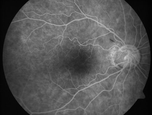 Progressive Outer Retinal Necrosis 77 Year Old Woman with CLL (Acute Retinal Necrosis) (PORN - ARN)
77-year-old woman with CLL who had shingles on the left side of her face about 6 weeks ago then she developed a dendrite in the cornea which was treating about four weeks ago.  She noticed severe vision loss in the left eye just a few days ago and you saw retinitis and she comes in because of that.   Vision OD is 20/25, OS is hand motion
