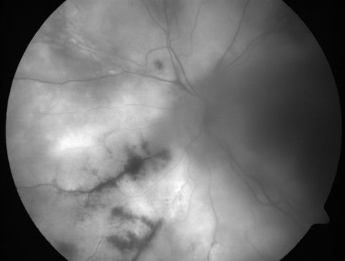 Progressive Outer Retinal Necrosis 77 Year Old Woman with CLL (Acute Retinal Necrosis) (PORN - ARN)
77-year-old woman with CLL who had shingles on the left side of her face about 6 weeks ago then she developed a dendrite in the cornea which was treating about four weeks ago.  She noticed severe vision loss in the left eye just a few days ago and you saw retinitis and she comes in because of that.   Vision OD is 20/25, OS is hand motion
