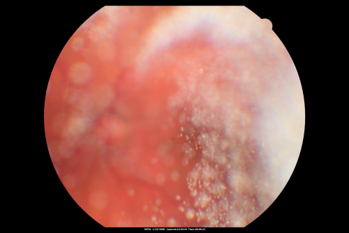 Asteroid Hyalosis - Asymptomatic
80-year-old woman her vision is not bothering her, you noticed a problem with the retina. Her left eye tests worse than the right eye today, but she says that it has been like that for a long time and she is not bothered by any floaters or change in central vision.
VISUAL ACUITY: OD is 20/25, OS 20/40
Keywords: floaters;asteroid;