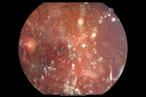 80 year old woman with Reticular Drusen (pseudodrusen) 20/30 Vision - Before Vitrectomy
80 year old woman with asteroid hyalosis and macular degeneration.

OPHTHALMIC EXAMINATION: Visual acuity with correction 20/30-3 OD and 20/30-2 
