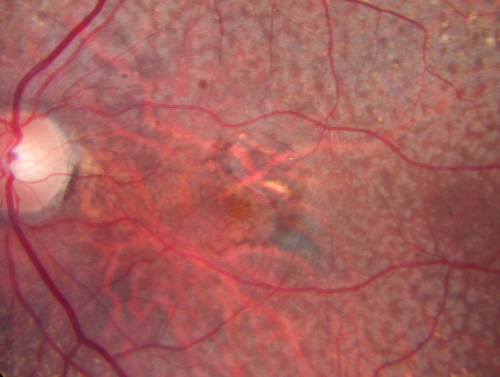 80 year old woman with Reticular Drusen (pseudodrusen) 20/30 Vision
80 year old woman with asteroid hyalosis and macular degeneration.

OPHTHALMIC EXAMINATION: Visual acuity with correction 20/30-3 OD and 20/30-2 
