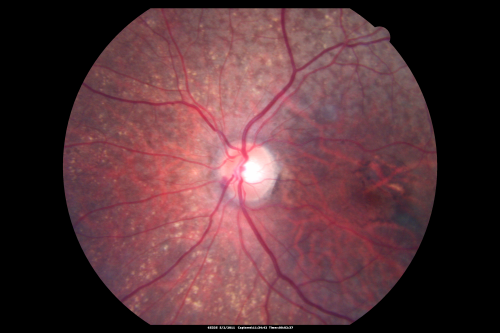 80 year old woman with Reticular Drusen (pseudodrusen) 20/30 Vision
80 year old woman with asteroid hyalosis and macular degeneration.

OPHTHALMIC EXAMINATION: Visual acuity with correction 20/30-3 OD and 20/30-2 
