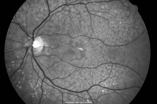 80 year old woman with Reticular Drusen (pseudodrusen) 20/30 Vision
80 year old woman with asteroid hyalosis and macular degeneration.

OPHTHALMIC EXAMINATION: Visual acuity with correction 20/30-3 OD and 20/30-2 
