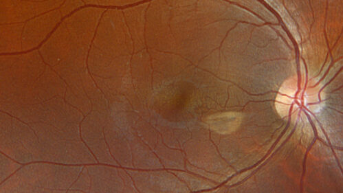 Astrocytoma (Astrocytic Hamartoma) no calcification
38 year old man with no symptoms
