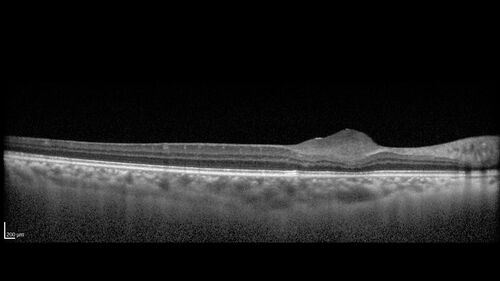 Astrocytoma (Astrocytic Hamartoma) no calcification
38 year old man with no symptoms
