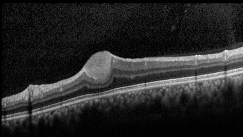 Astrocytoma (Astrocytic Hamartoma) no calcification
38 year old man with no symptoms
