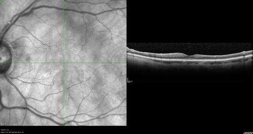 Branch Retinal Arterial Occlusion Right Eye - Atheromata - Both Eyes
83 year old woman with no symptoms - VA 20/40 in both eyes.  Right eye has ST BRAO with silver wiring.  Left eye has superotemporal atheromata
