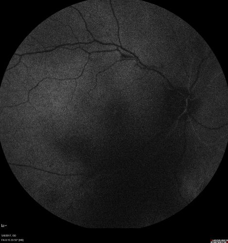Branch Retinal Arterial Occlusion Right Eye - Atheromata - Both Eyes
83 year old woman with no symptoms - VA 20/40 in both eyes.  Right eye has ST BRAO with silver wiring.  Left eye has superotemporal atheromata
