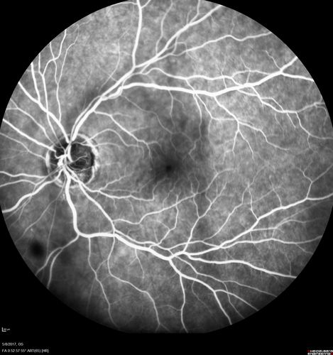 Branch Retinal Arterial Occlusion Right Eye - Atheromata - Both Eyes
83 year old woman with no symptoms - VA 20/40 in both eyes.  Right eye has ST BRAO with silver wiring.  Left eye has superotemporal atheromata
