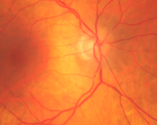Retinal Arterial Atheromata
68-year-old woman with records going back 7 years, which clearly document retinal arterial plaques in both eyes. 
Palabras clave: plaque;atheromata;crystal