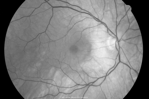 Retinal Arterial Atheromata
68-year-old woman with records going back 7 years, which clearly document retinal arterial plaques in both eyes. 
Keywords: plaque;atheromata;crystal