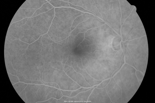 Retinal Arterial Atheromata
68-year-old woman with records going back 7 years, which clearly document retinal arterial plaques in both eyes. 
Võtmesõnad: plaque;atheromata;crystal