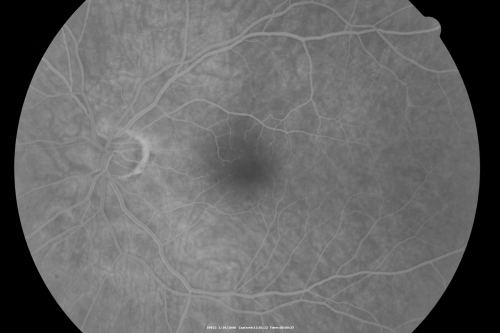 Retinal Arterial Atheromata
68-year-old woman with records going back 7 years, which clearly document retinal arterial plaques in both eyes. 
Keywords: plaque;atheromata;crystal