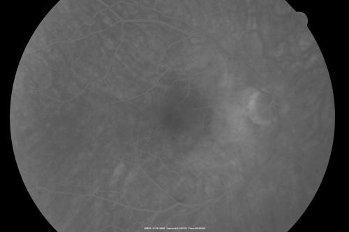 Retinal Arterial Atheromata
68-year-old woman with records going back 7 years, which clearly document retinal arterial plaques in both eyes. 
Keywords: plaque;atheromata;crystal