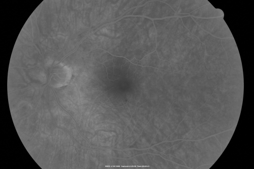 Retinal Arterial Atheromata
68-year-old woman with records going back 7 years, which clearly document retinal arterial plaques in both eyes. 
Keywords: plaque;atheromata;crystal