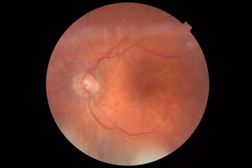 Autoimmune Retinopathy
91 year old female with severe vision loss over the past 3 years.  She has shimmery scotomas.  The main findings are outer retinal atrophy evident on OCT and FAF.  VA 20/80 OD and 20/125 OS
