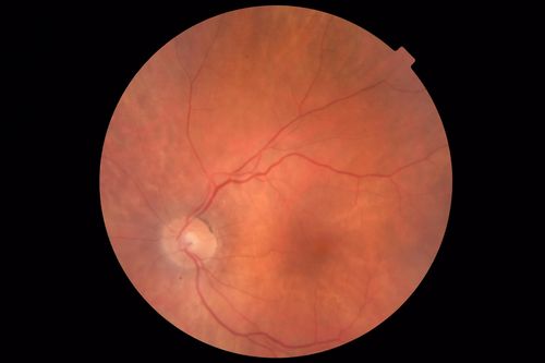 Autoimmune Retinopathy
91 year old female with severe vision loss over the past 3 years.  She has shimmery scotomas.  The main findings are outer retinal atrophy evident on OCT and FAF.  VA 20/80 OD and 20/125 OS

