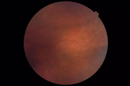 Autoimmune Retinopathy
91 year old female with severe vision loss over the past 3 years.  She has shimmery scotomas.  The main findings are outer retinal atrophy evident on OCT and FAF.  VA 20/80 OD and 20/125 OS
